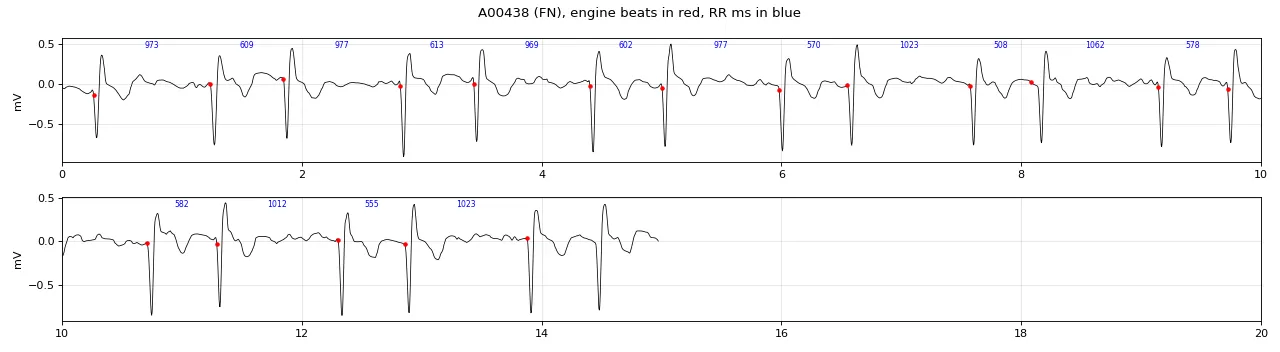Bigeminal rhythm labelled AF in the public set